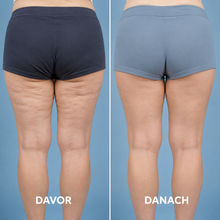 Lade das Bild in den Galerie-Viewer, Formkur - Anti-Cellulite- &amp; Bindegewebs-Massagegerät
